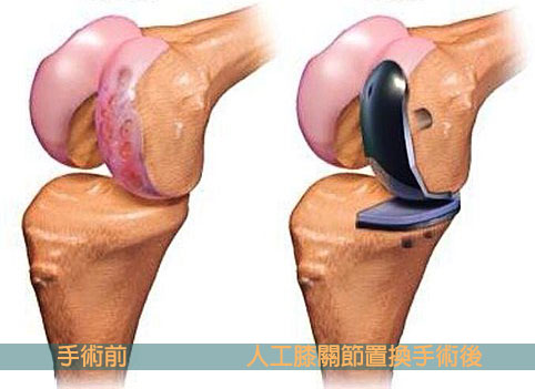 膝关节置换术