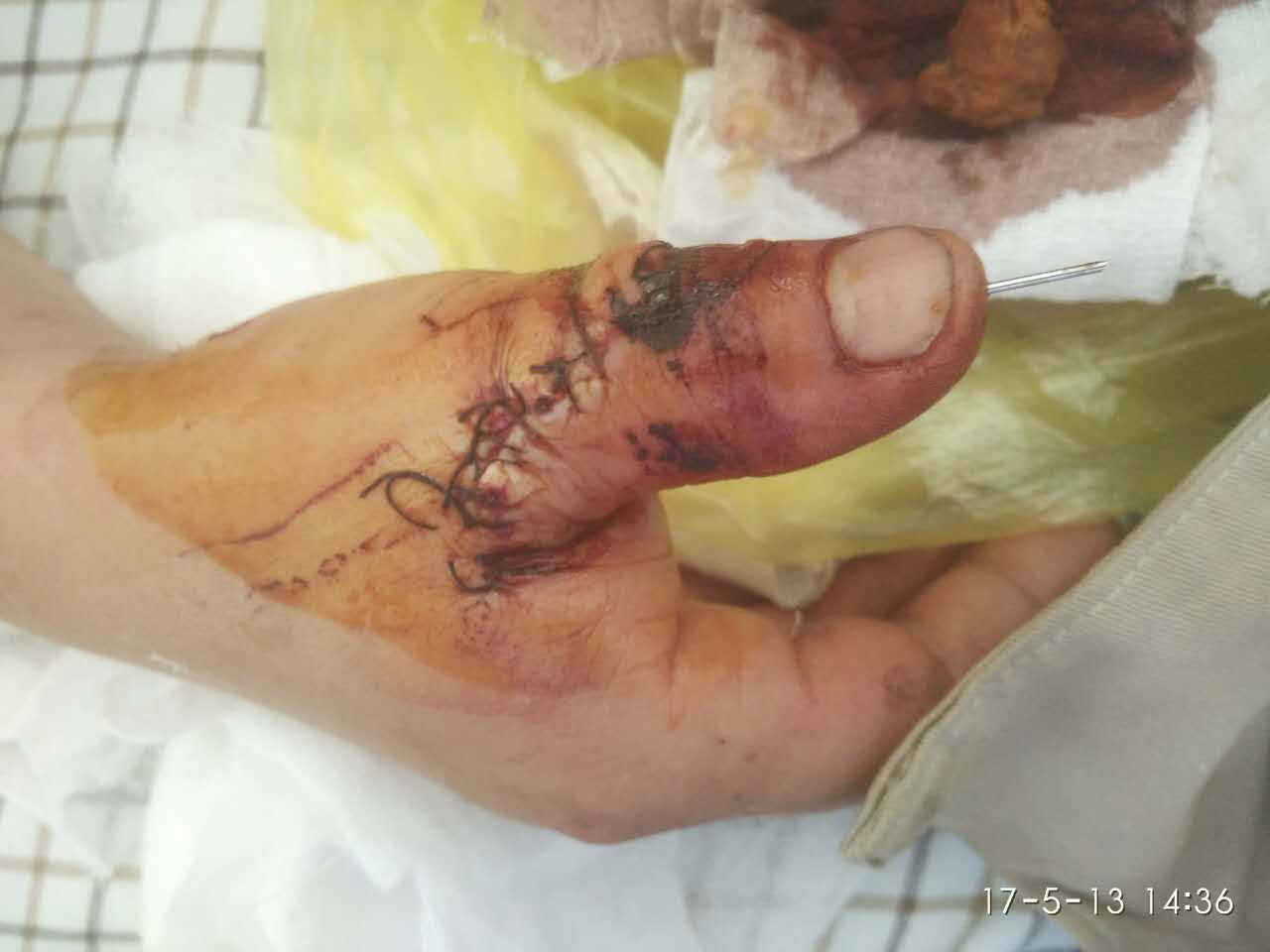 断指再植患者大拇指已能自由活动