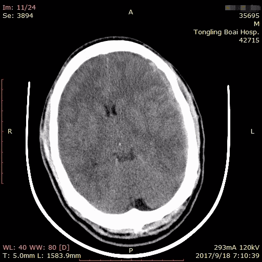 患者入院时脑CT并未见明显血肿
