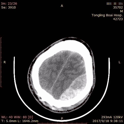 观察约2小时后复查CT，右下角白色部分明显血肿